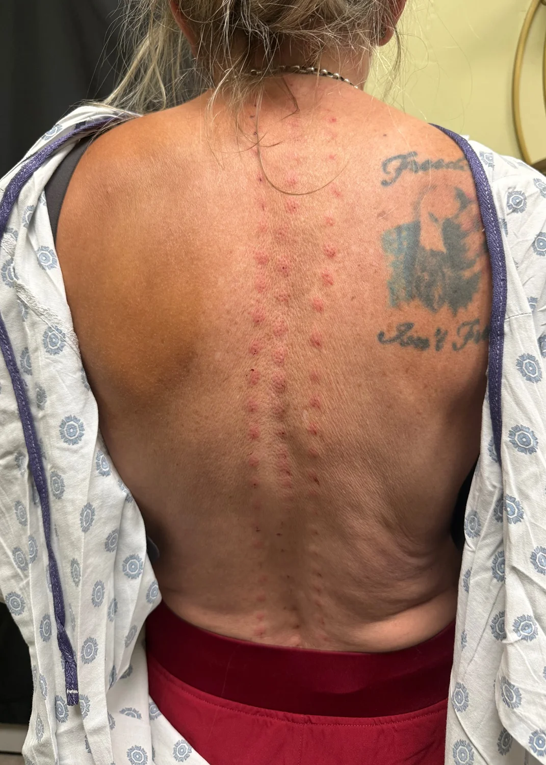 Procaine neural therapy